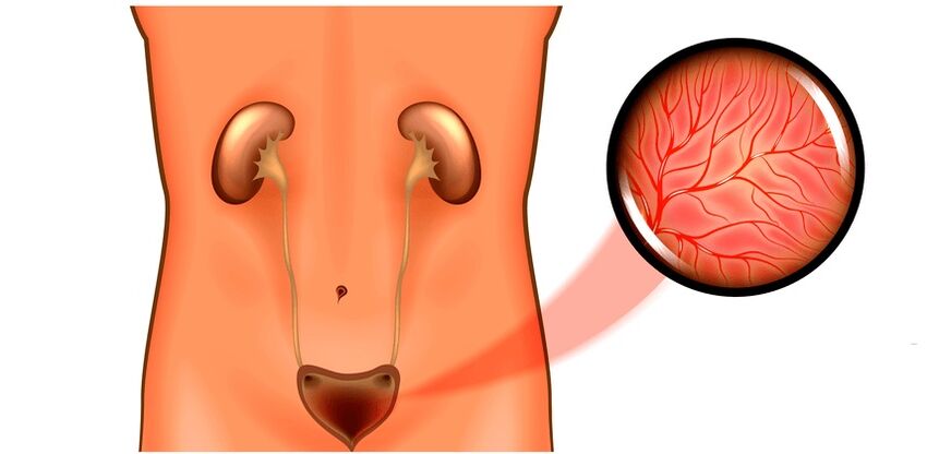 Cystitis in male symptoms and treatment