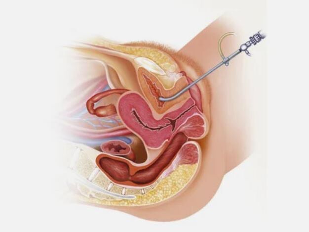 Diagnosis of cystitis